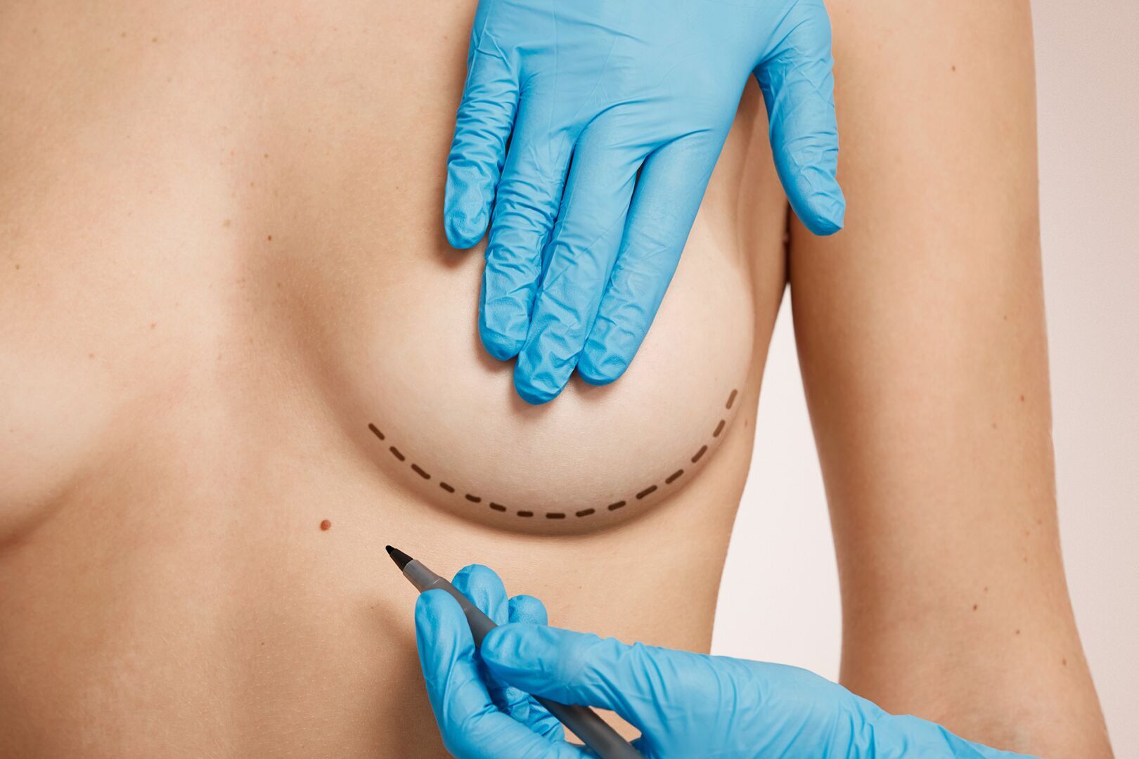 Breast Augmentation (Implants / Fat Transfer)