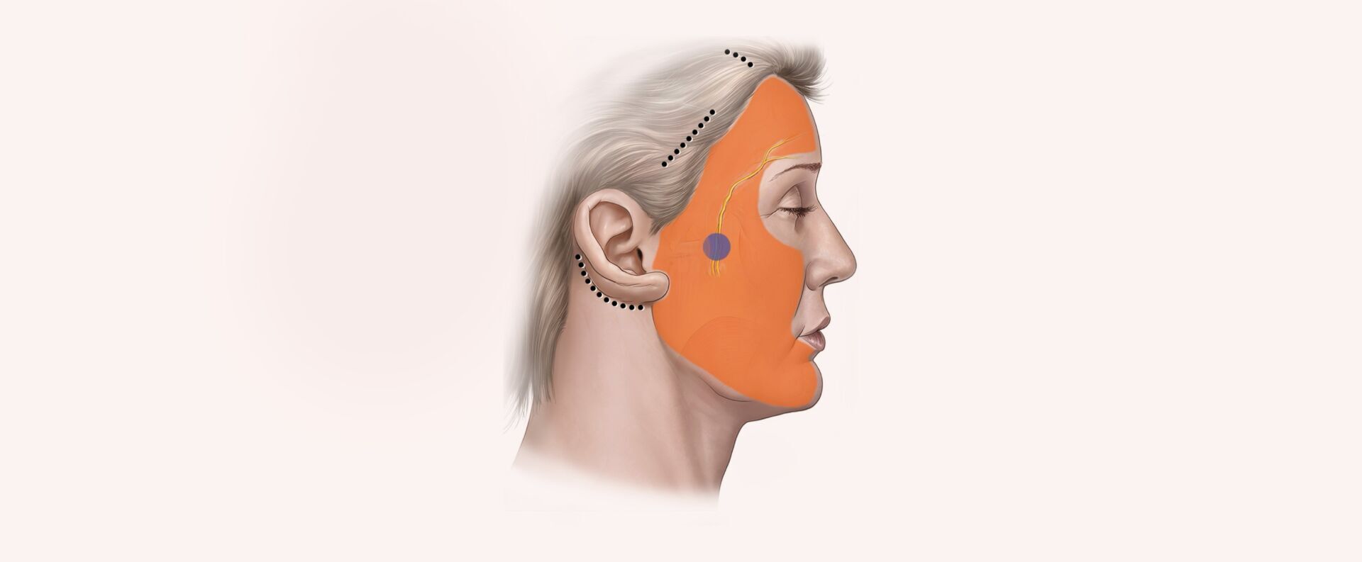 Endoscopic Facelift Type V