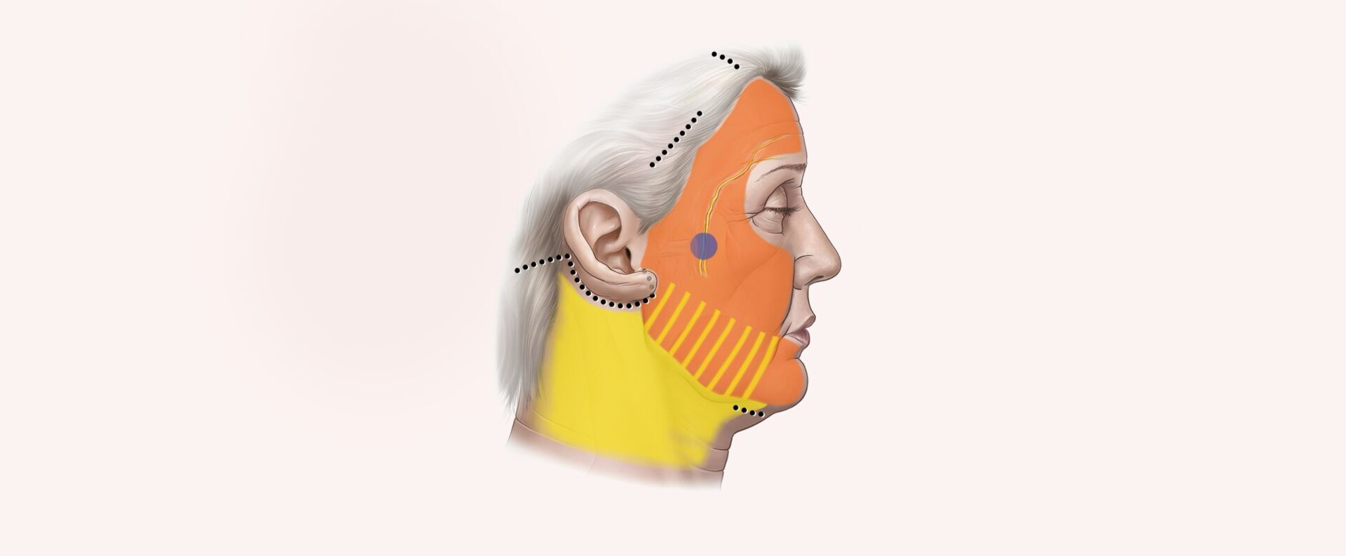 Endoscopic Facelift Type II