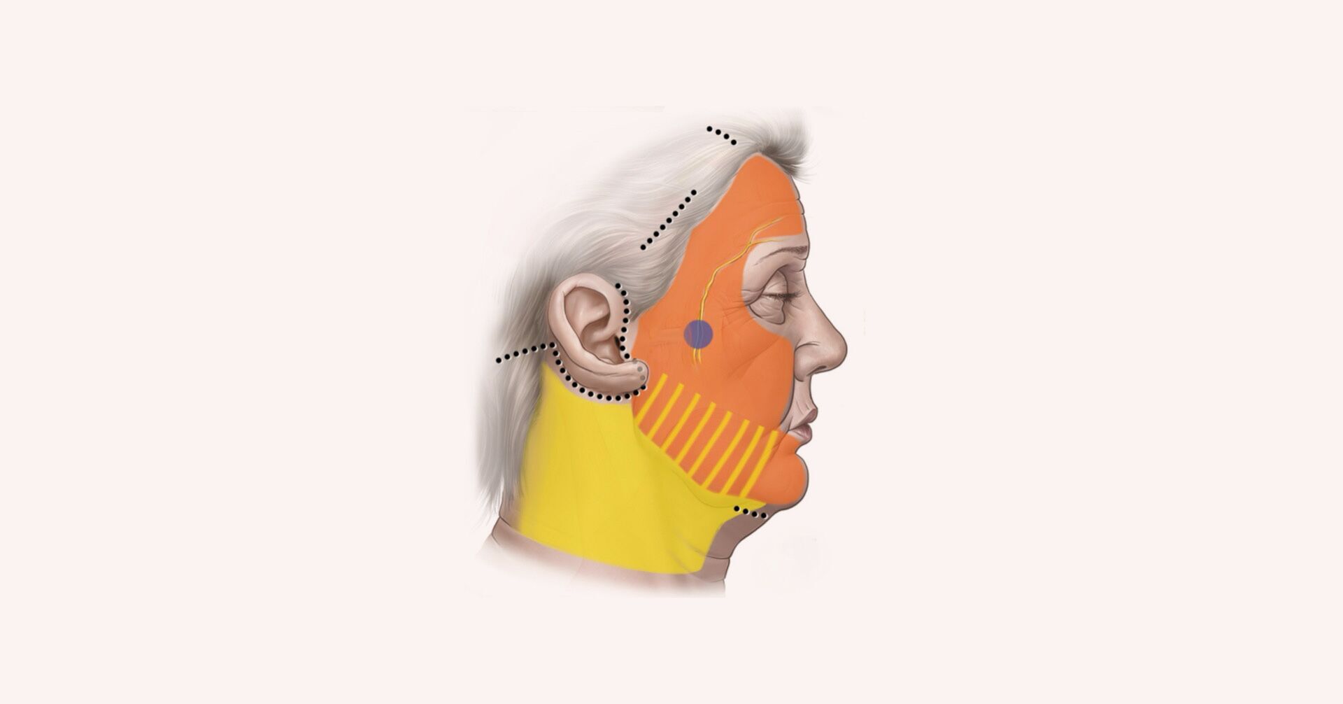 Deep Plane FaceLift Surgery