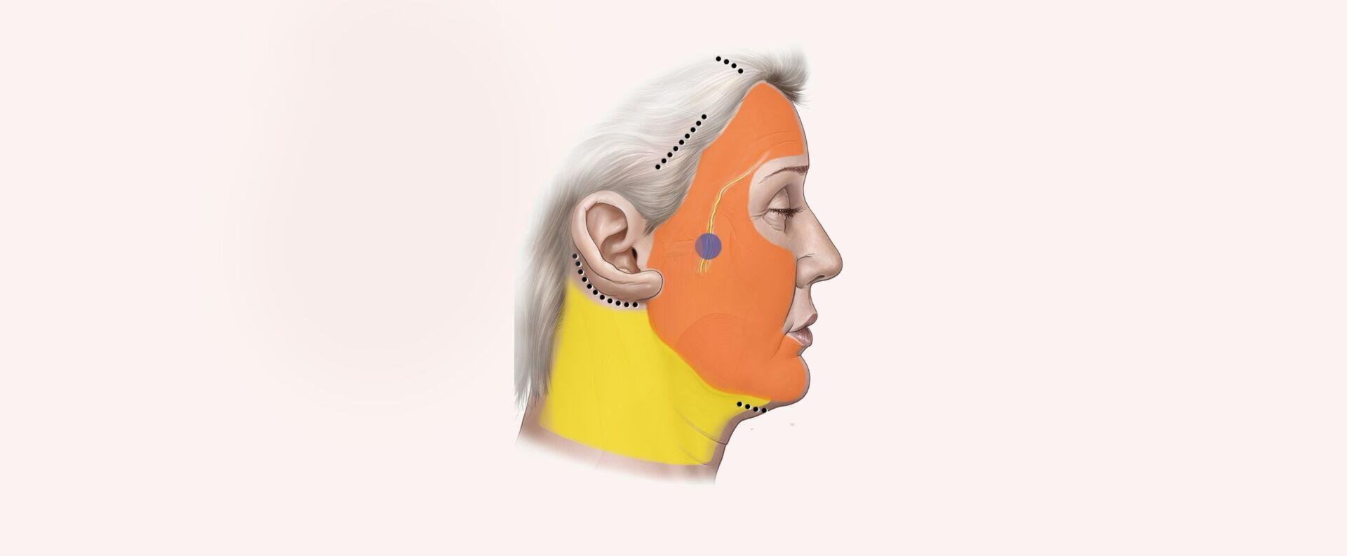 Endoscopic Hybrid FaceLift