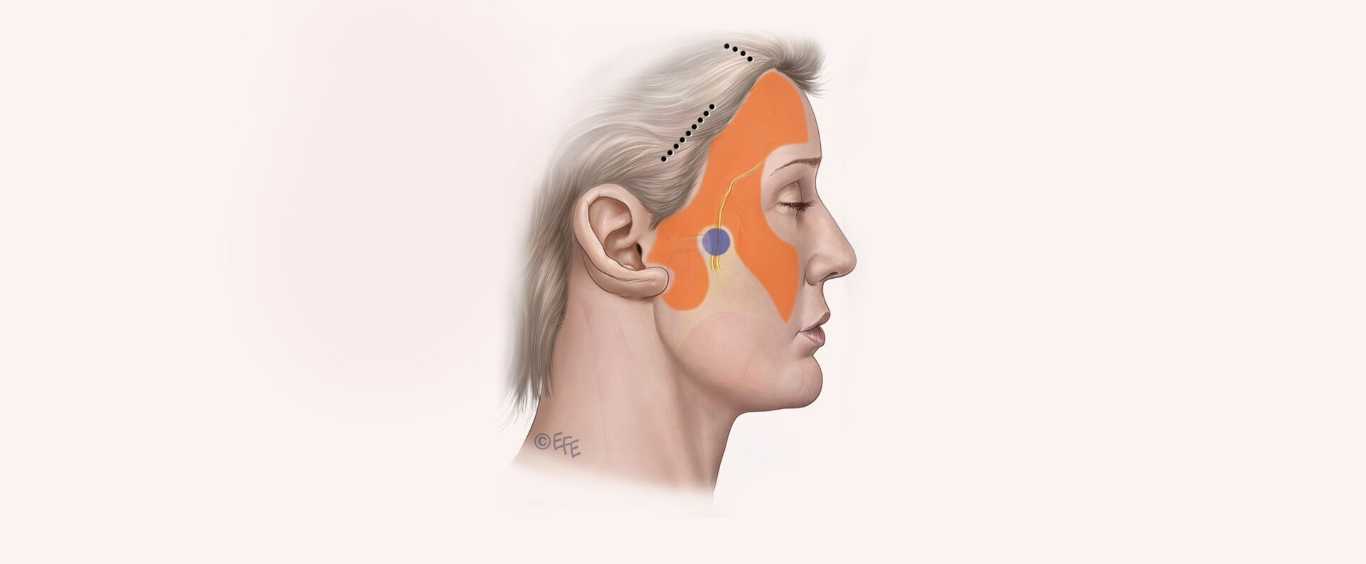 Short-Scar Deep-Plane FaceLift