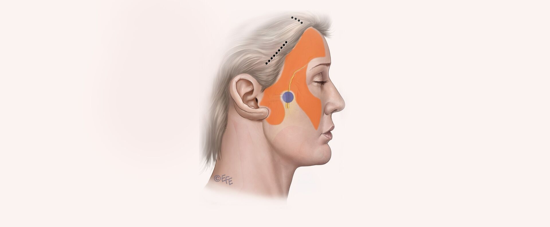 Endoscopic Facelift Type 1