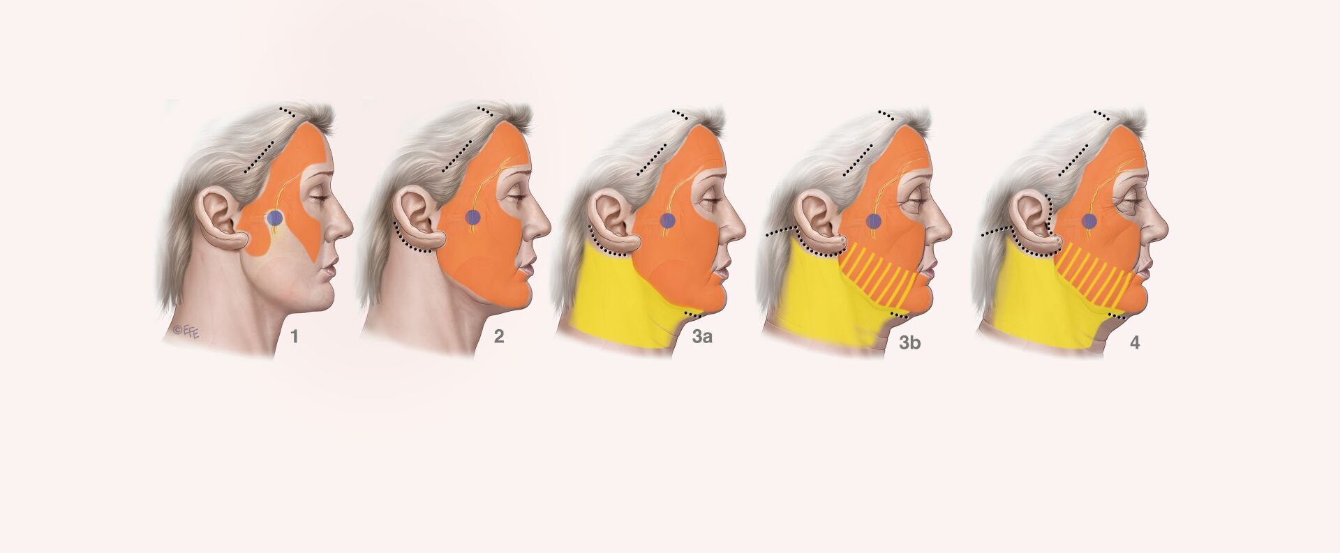 What is Endoscopic Facelift Surgery