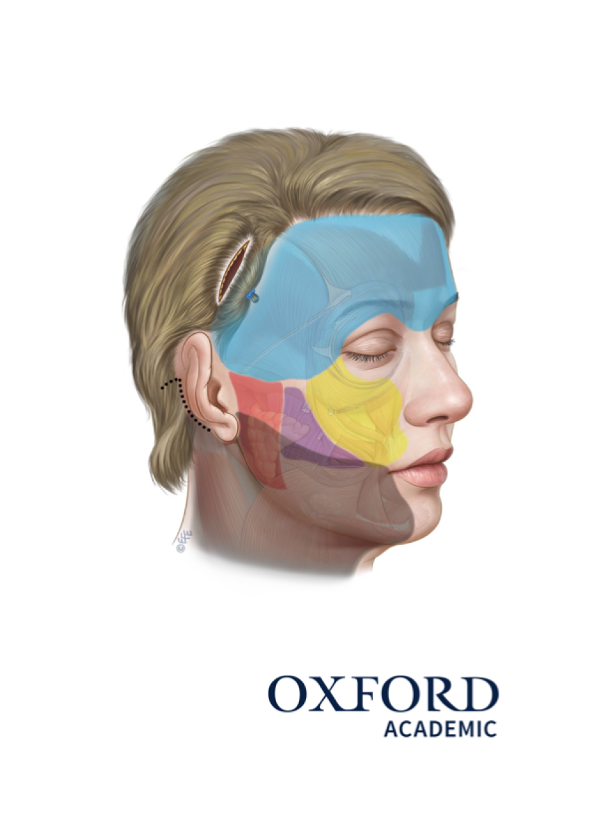 Endoscopic Facelift Techniques