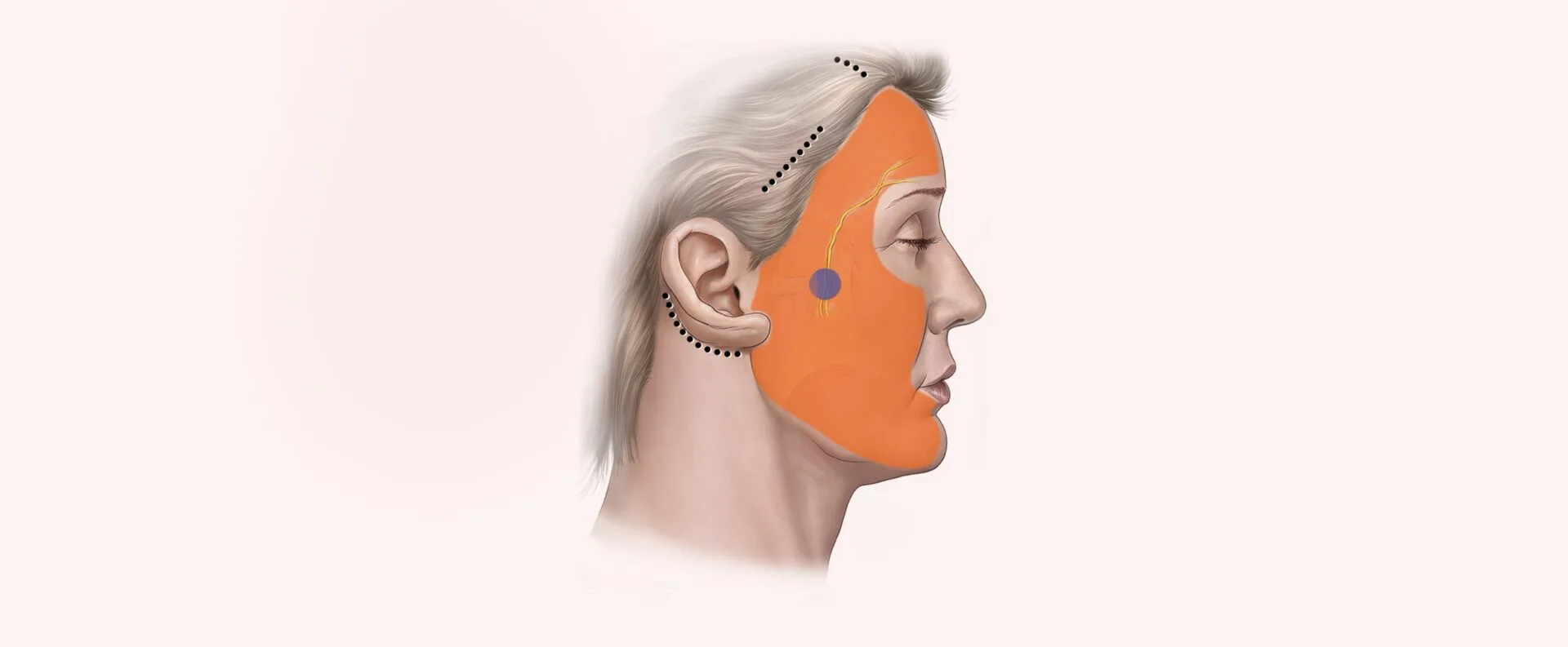 Endoscopic Facelift Type V