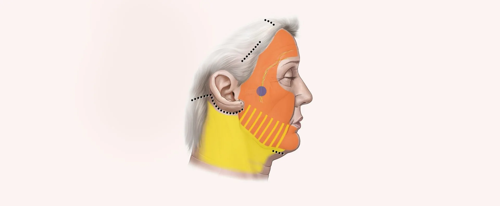 Endoscopic Facelift Type II