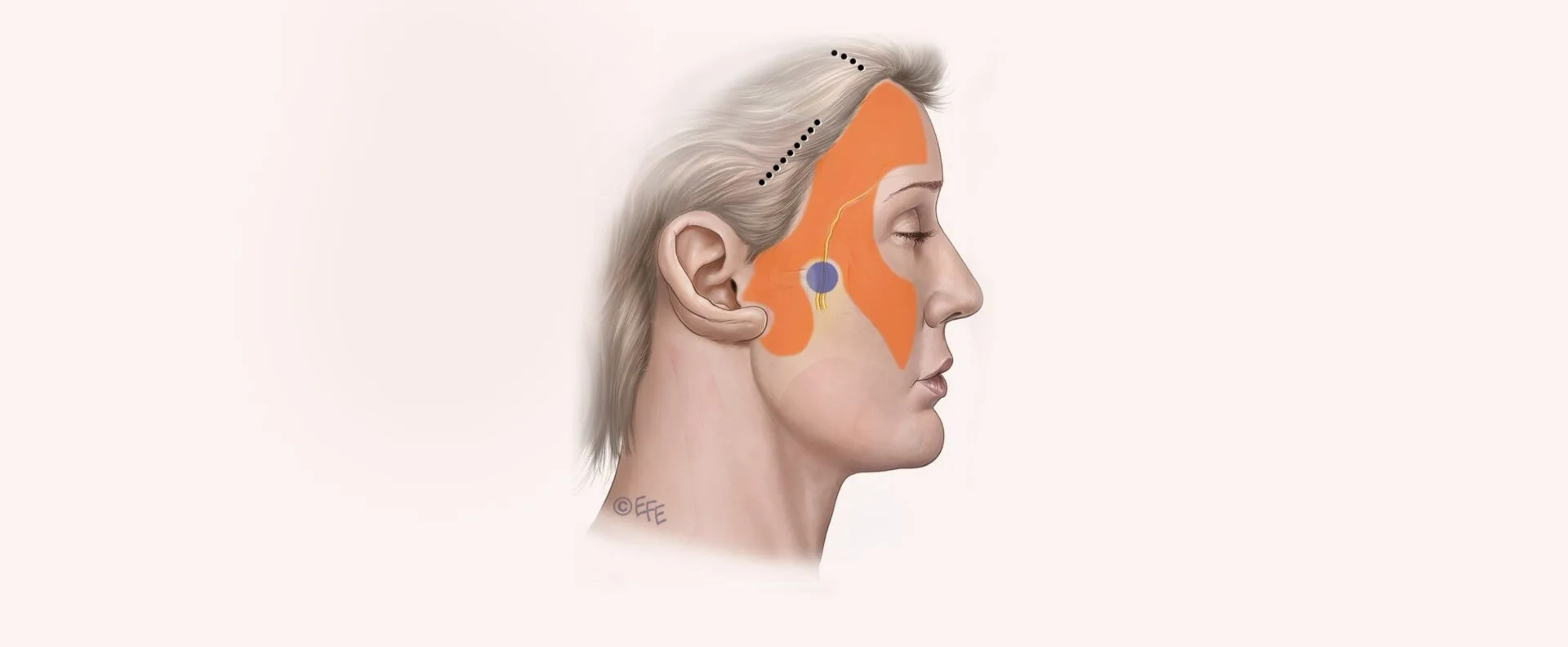 Short-Scar Deep-Plane FaceLift