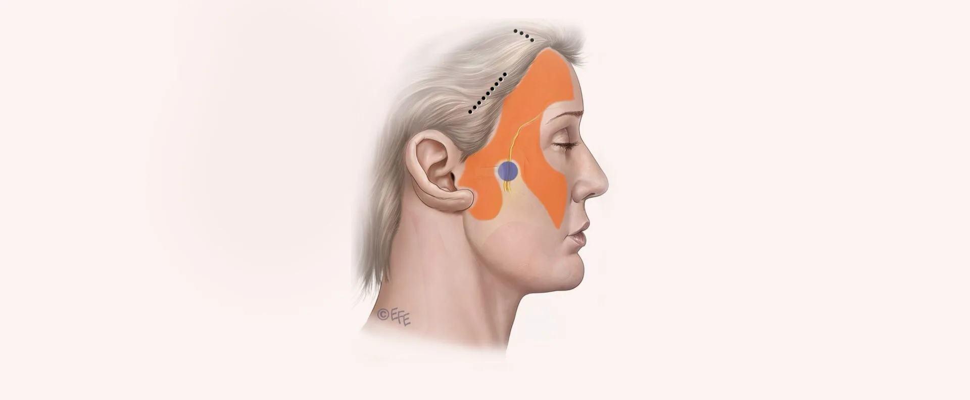 Endoscopic Facelift Type 1