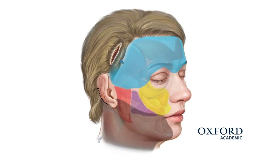 Endoscopic Facelift Techniques